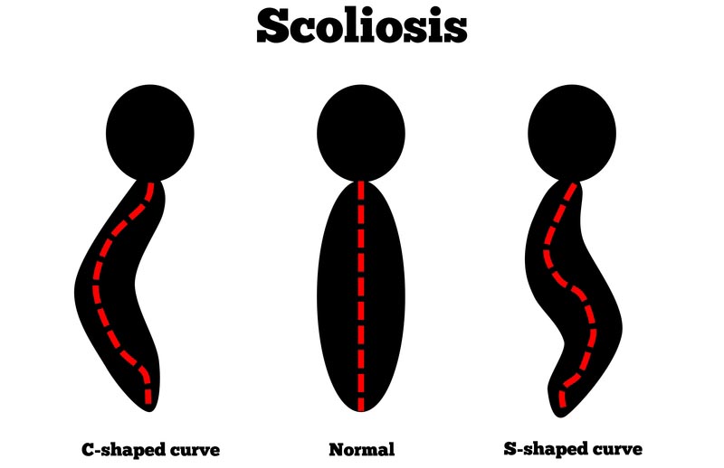 Paramus, NJ scoliosis treatment